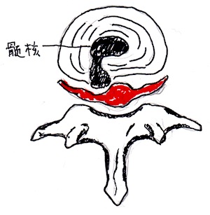 ヘルニアの図
